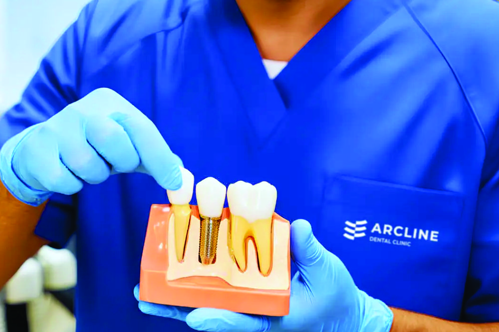 Implantul dentar – Ce trebuie să știi despre el